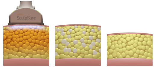 SculpSure Animation Corp site 3 image version.png