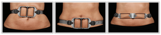 treatement frames abs.png